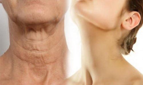 Vùng da cổ, ngực chảy xệ xuất hiện cùng dấu hiệu lão hoá