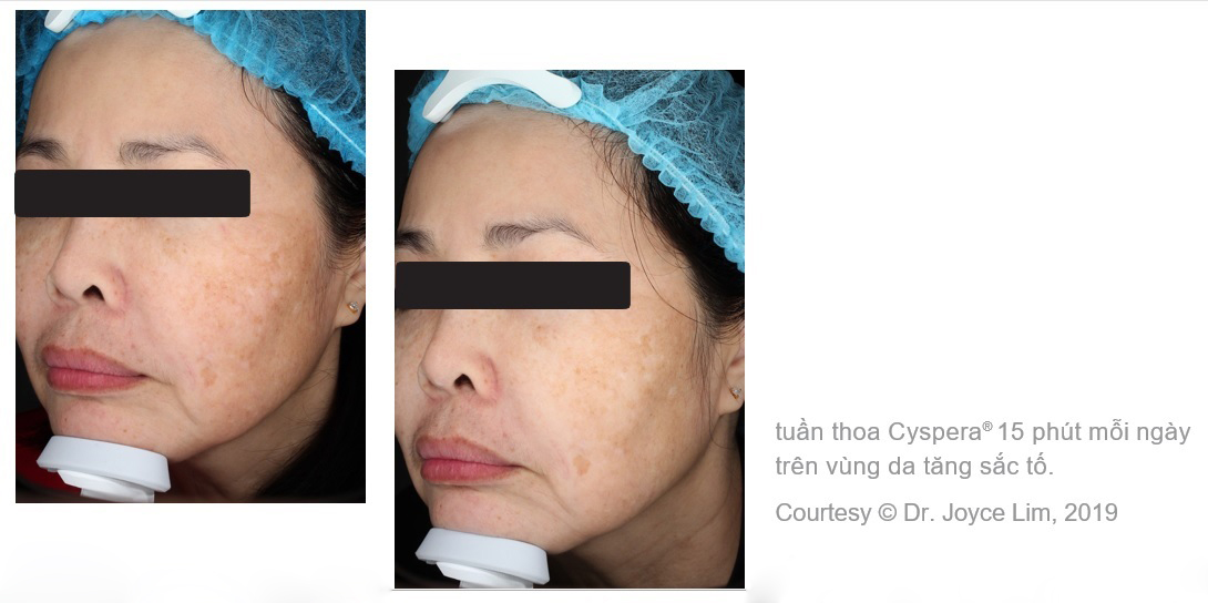 Kết quả cải thiện tình trạng nám da mặt khi sử dụng kem trị nám Cyspera