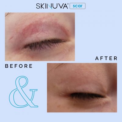 Kem trị sẹo Skinuva Scar phù hợp với cả vùng da mắt mỏng và nhạy cảm