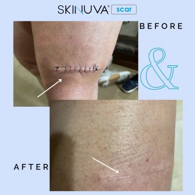 Kết quả điều trị sẹo bằng kem trị sẹo Skinuva Scar