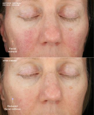 Trước và sau khi sử dụng Dermal Repair Cream sau 2 tuần
